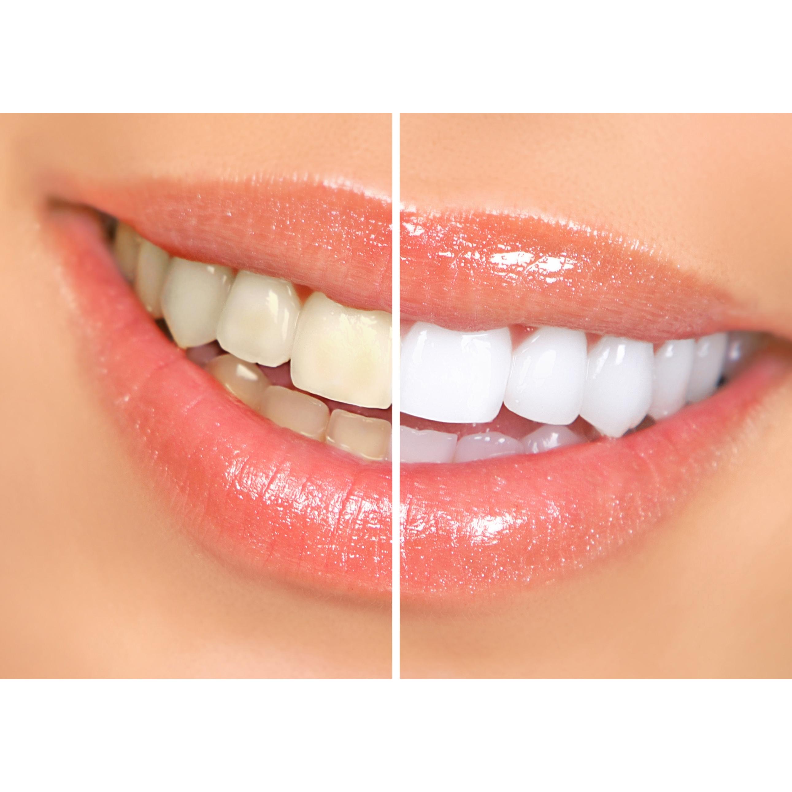 Jolie Blanc Teeth Whitening