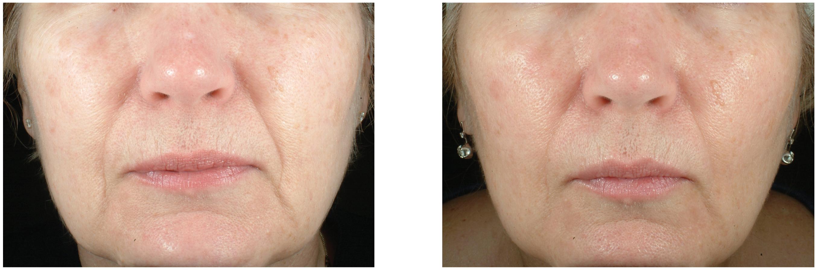 eMatrix Skin Resurfacing & Collagen Rejuvenation after just 1 treatment.