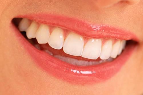 Veneers