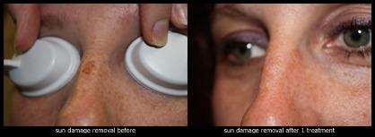 Sun damage removal before, 1 month after treatment 1