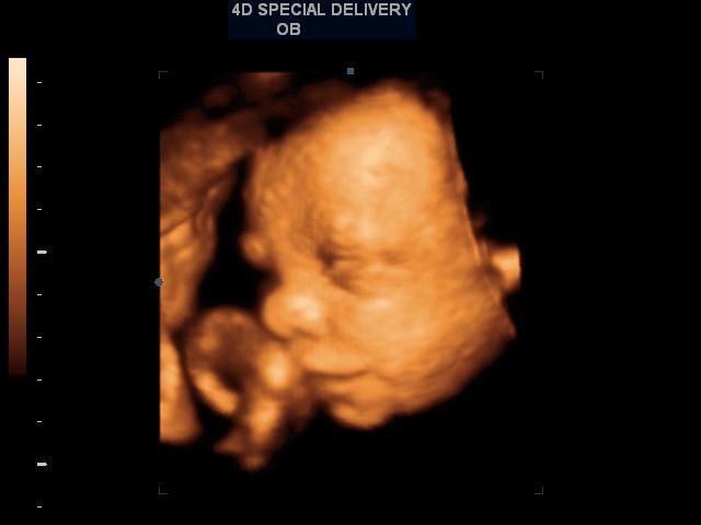 3D4D Ultrasound