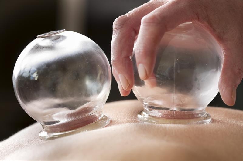 Cupping Treatment