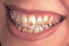 Gold Braces