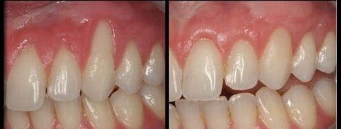 Gingival Grafting - Before and After