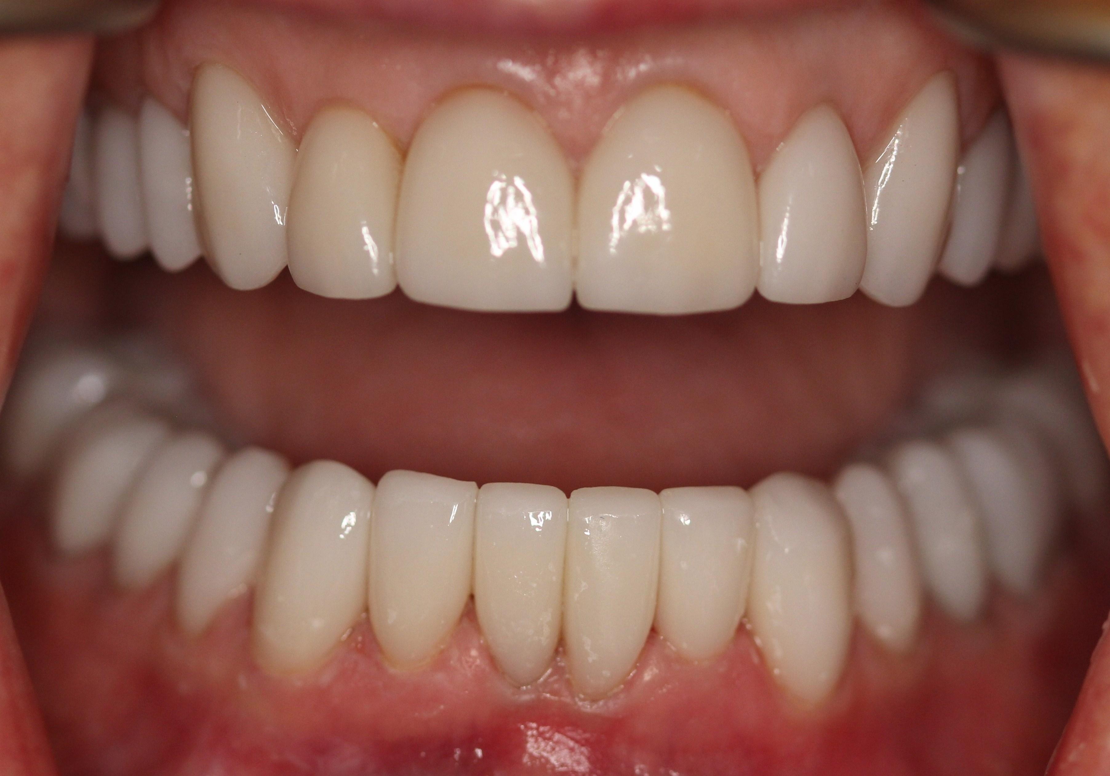 Full mouth reconstruction, including 24 crowns