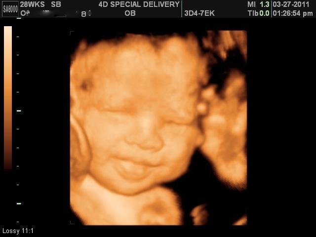 3D 4D Ultrasound by 4D Special Delivery