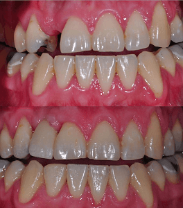 dental implant