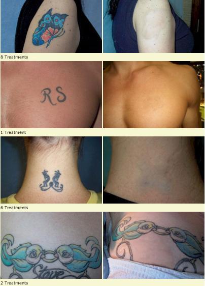 Elkhart Tattoo Removal