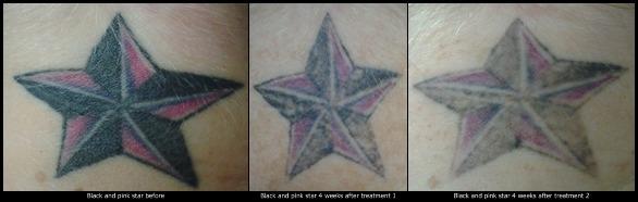 Laser tattoo removal progression: before, 1 month after treatment 1, 1 month after treatment 2