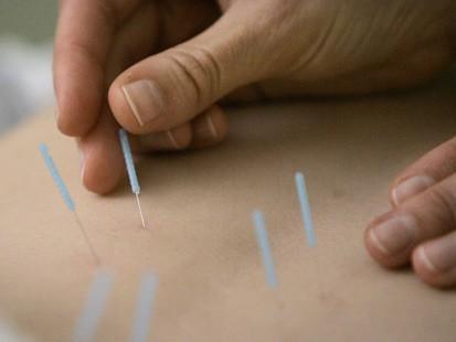 Acupuncture with Dr.Zhou