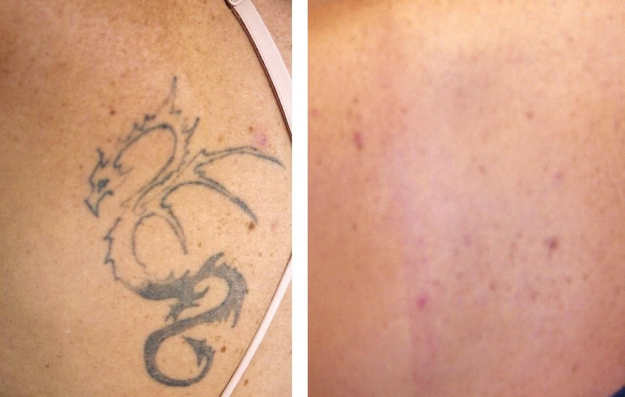 Dr. Hirsch Tattoo Removal Sarasota