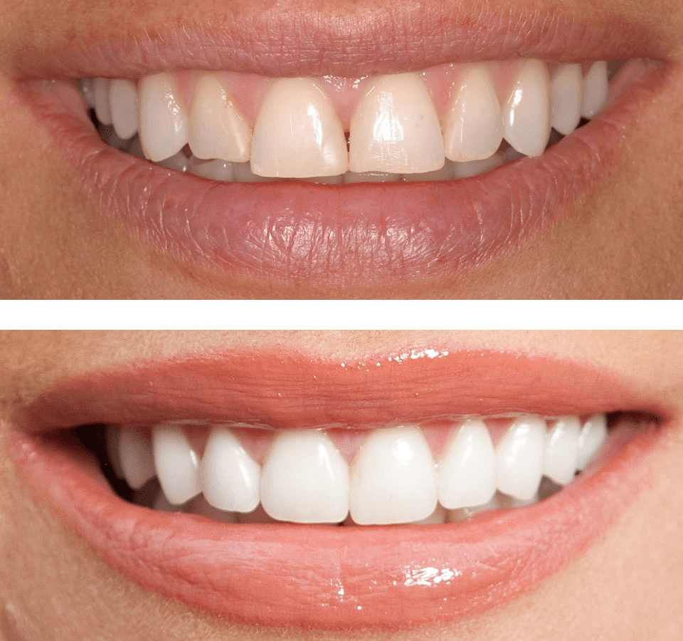 Cosmetic Dentistry - Before and After