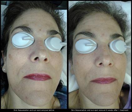 Laser skin rejuvenation and sun spot removal before, 1 month after treatment 1