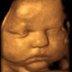 Chubby cheeks caputred with 3D/4D Ultrasound