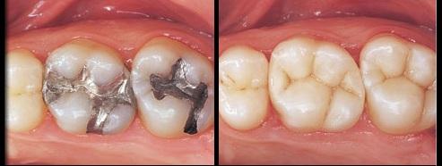 Tooth Colored Fillings - Before and After