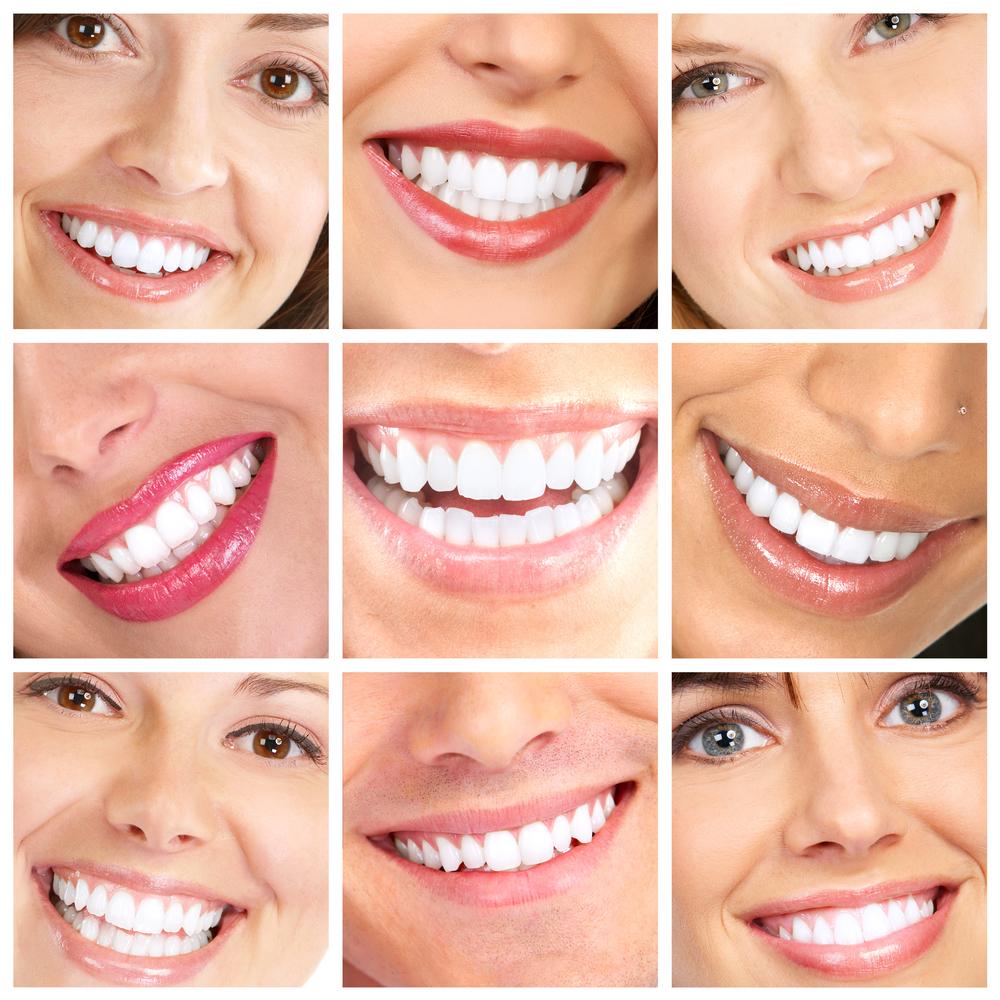 Teeth Whitening