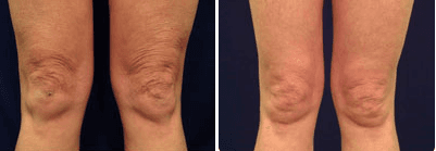 Laser Skin Tightening Before & After at Blue Water Spa