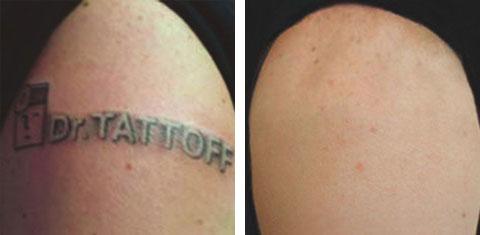 Dr. TATTOFF - Laser Tattoo Removal and Laser Hair Removal