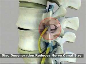 Degenerative Disc