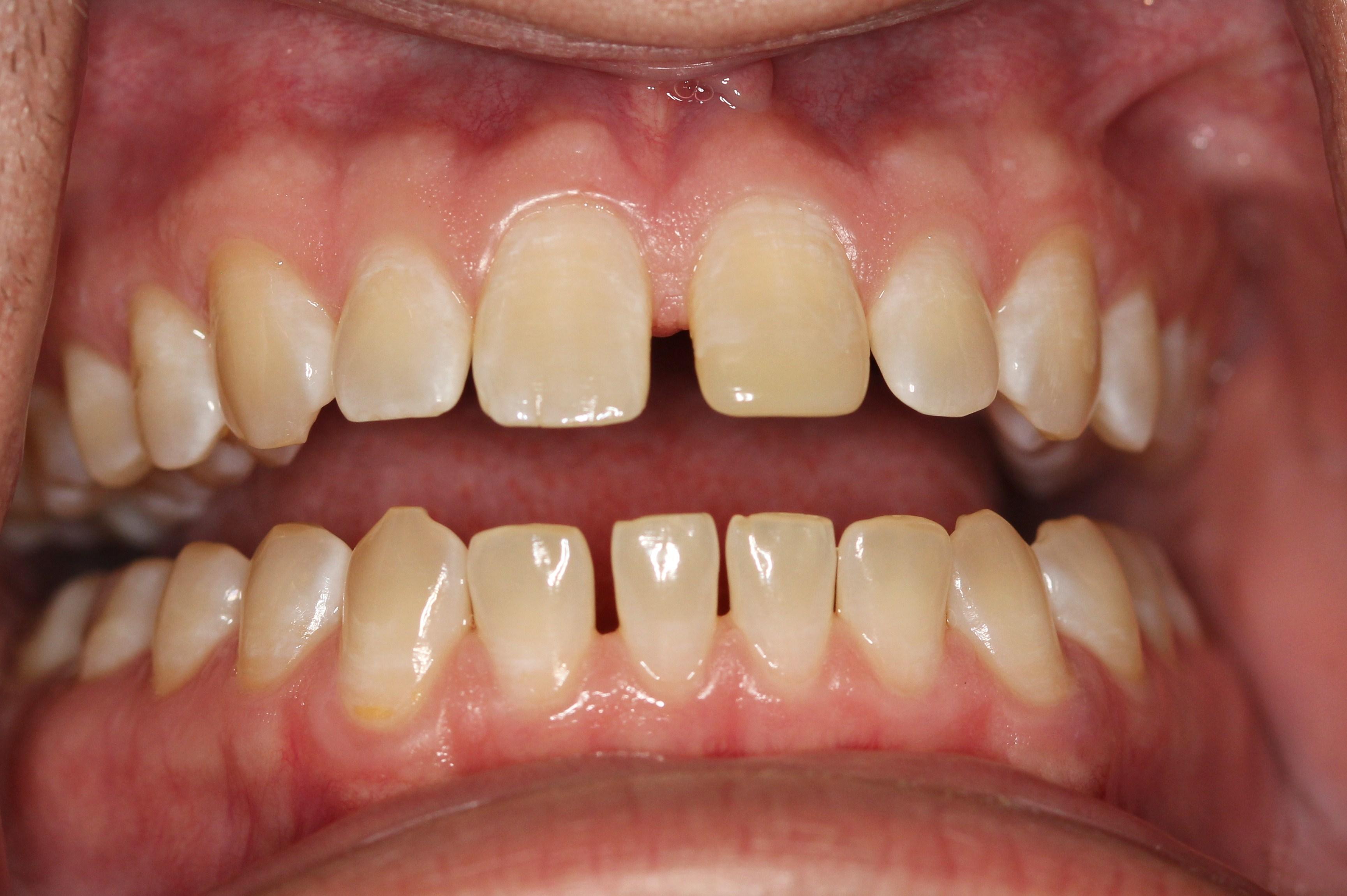 Spacing and yellow appearance of teeth