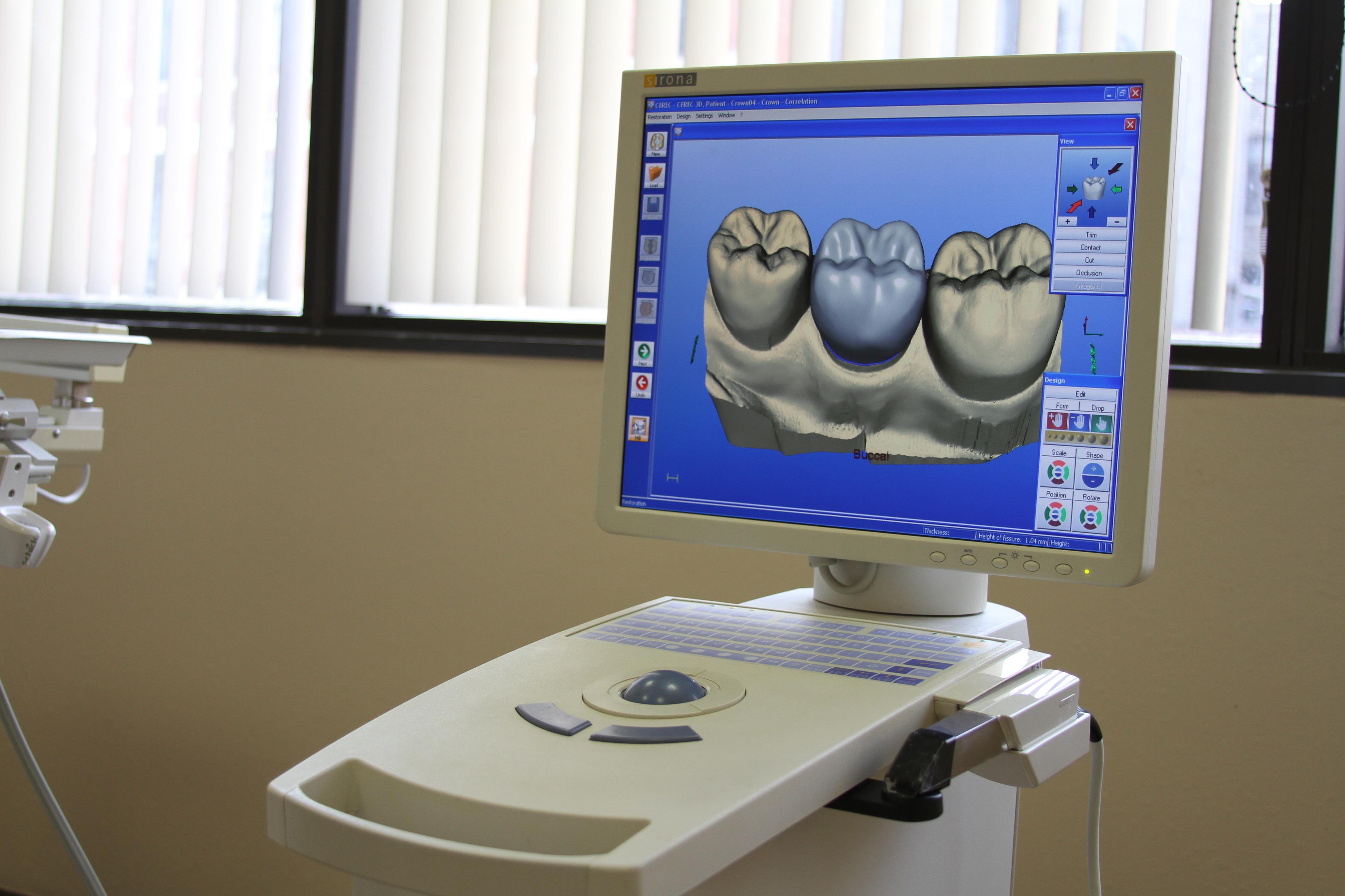 CEREC One Visit Crowns