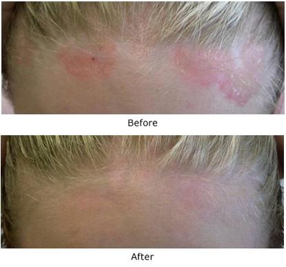 Psoriasis Treatment - Head