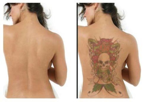 tattoo removal