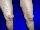 USA Vein Clinics