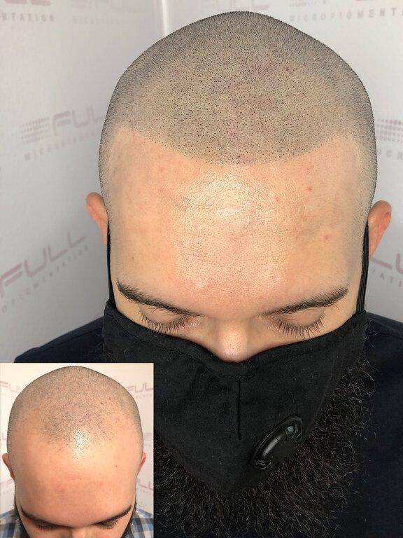 Full Micropigmentation