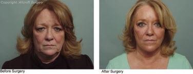 Allcroft Facial Plastic Surgery