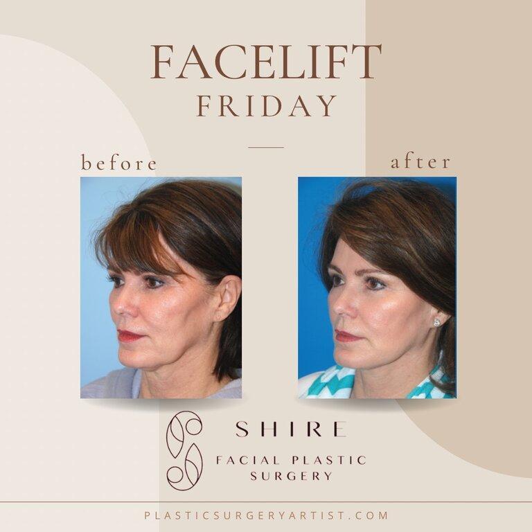 Shire Facial Plastic Surgery