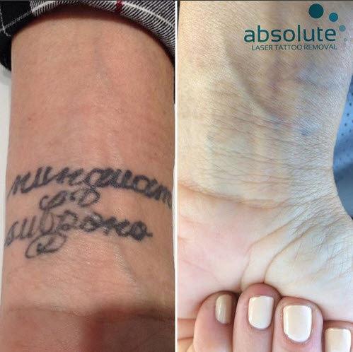 Absolute Laser Tattoo Removal