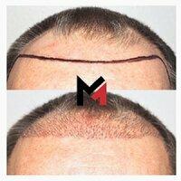 MAXIM Hair Restoration & Transplants - Sarasota