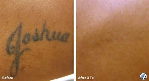 Eraser Clinic Laser Tattoo Removal