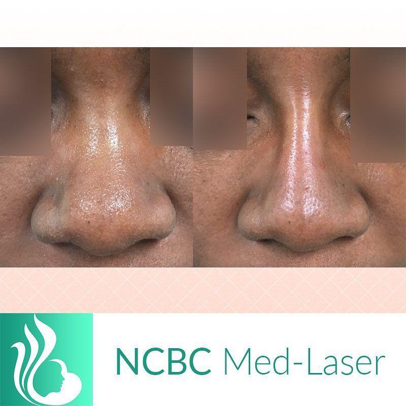 NCBC Med-Laser