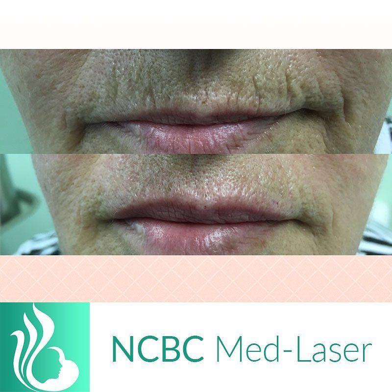 NCBC Med-Laser