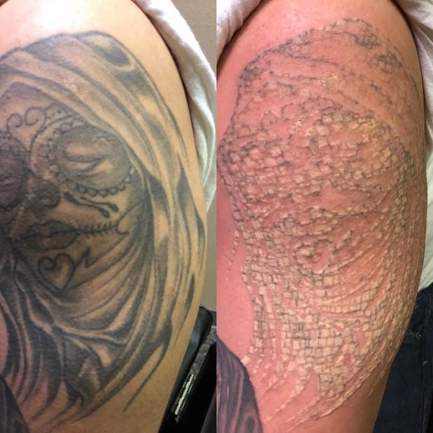 Before & After Laser Tattoo Removal