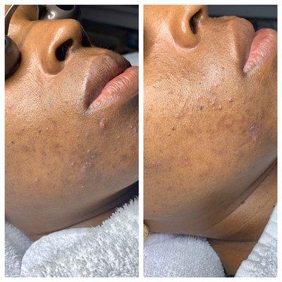 Before and after PCA Skin Chemical peel!