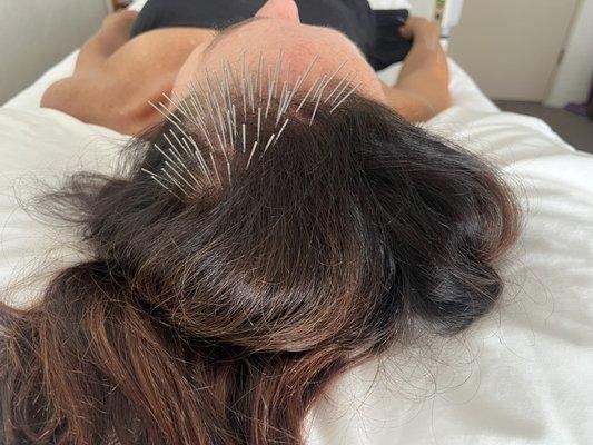 Hair regrowth treatment