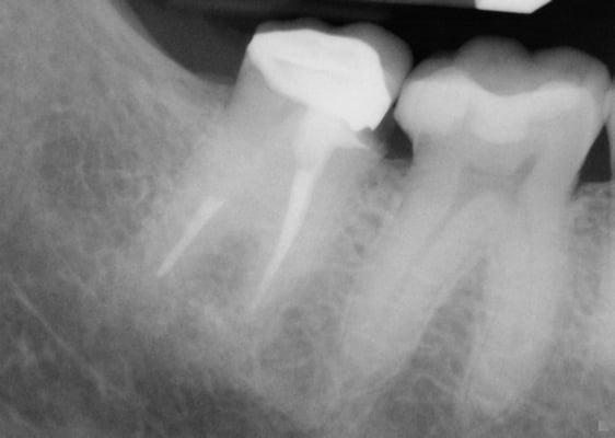 Tooth #31 (left) and #30 (right). Existing crown (pre-op).