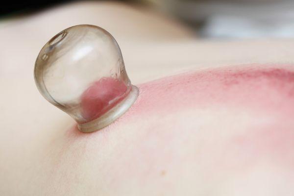 Cupping