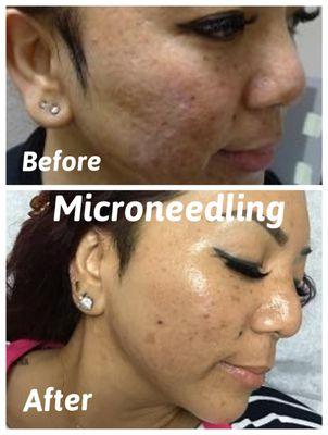 After 5th Tx Pt achieved an outstanding results. Micro needling promoted the growth of new collagen in her skin/ reducing acne  scars.