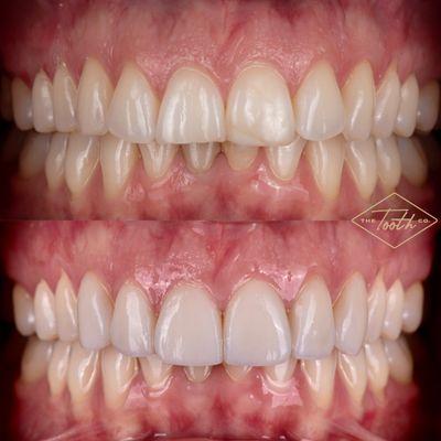 Porcelain Veneers