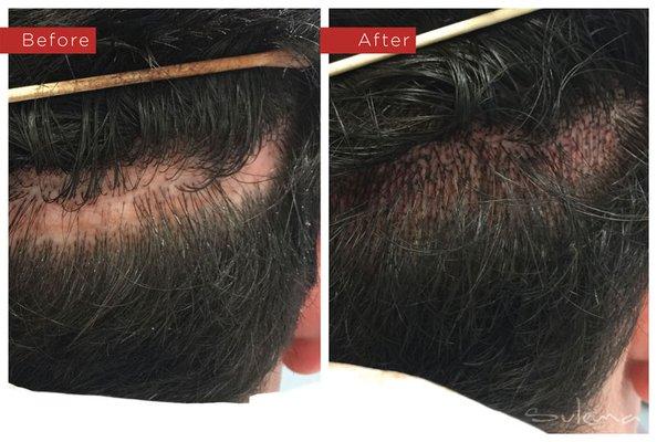 Scalp Micropigmentation (SMP)