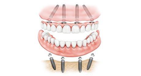 Teeth-in-a-Day All on Four Implants