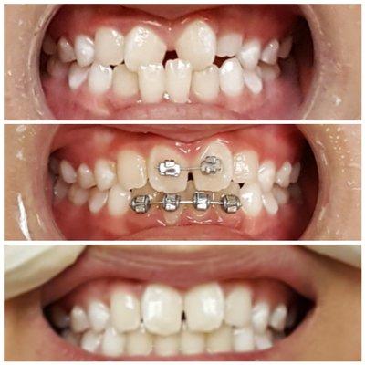 Eight years old, early correction of the cross-bite. Dr Thanh-Duc 2016