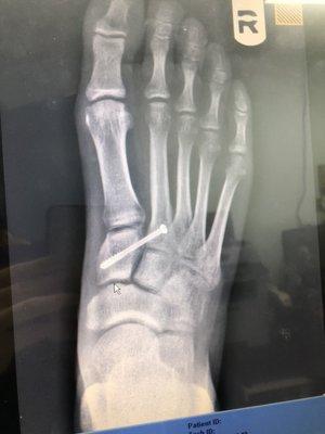 After surgery - Lisfranc fracture