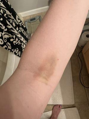 6 days after my blood draw...