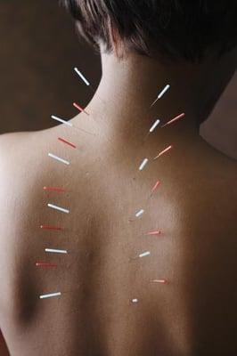 Acupuncture in Fort Lauderdale at Ocean Acupuncture and Wellness Center, LLC