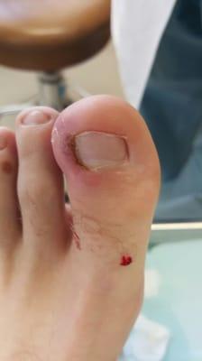 Ingrown toe nail